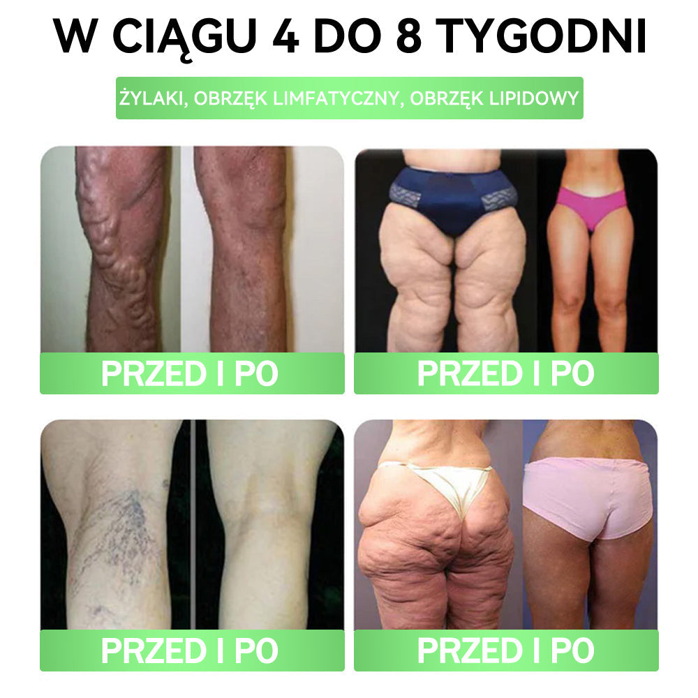 ✈️𝐀𝐍𝐆𝐄𝐋𝐓𝐑𝐀𝐏® 𝐌𝐨𝐫𝐢𝐧𝐠𝐚 × 𝐁𝐞𝐫𝐛𝐞𝐫𝐲𝐧𝐚 × 𝐀𝐌𝐏𝐊 𝟏𝟎-𝐰-𝟏 𝐖𝐬𝐩𝐚𝐫𝐜𝐢𝐞 𝐦𝐞𝐭𝐚𝐛𝐨𝐥𝐢𝐜𝐳𝐧𝐞, 𝐩𝐥𝐚𝐬𝐭𝐞𝐫 𝐳 𝐧𝐚𝐧𝐨𝐭𝐞𝐜𝐡𝐧𝐨𝐥𝐨𝐠𝐢ą 𝐦𝐢𝐤𝐫𝐨𝐢𝐠ł𝐨𝐰ą 🇵🇱(Wystarczy raz dziennie, widoczne efekty w 7 dni) ✅ Na otyłość, wiotką skórę, cukrzycę, bezdech senny, problemy ze stawami i wiele innych